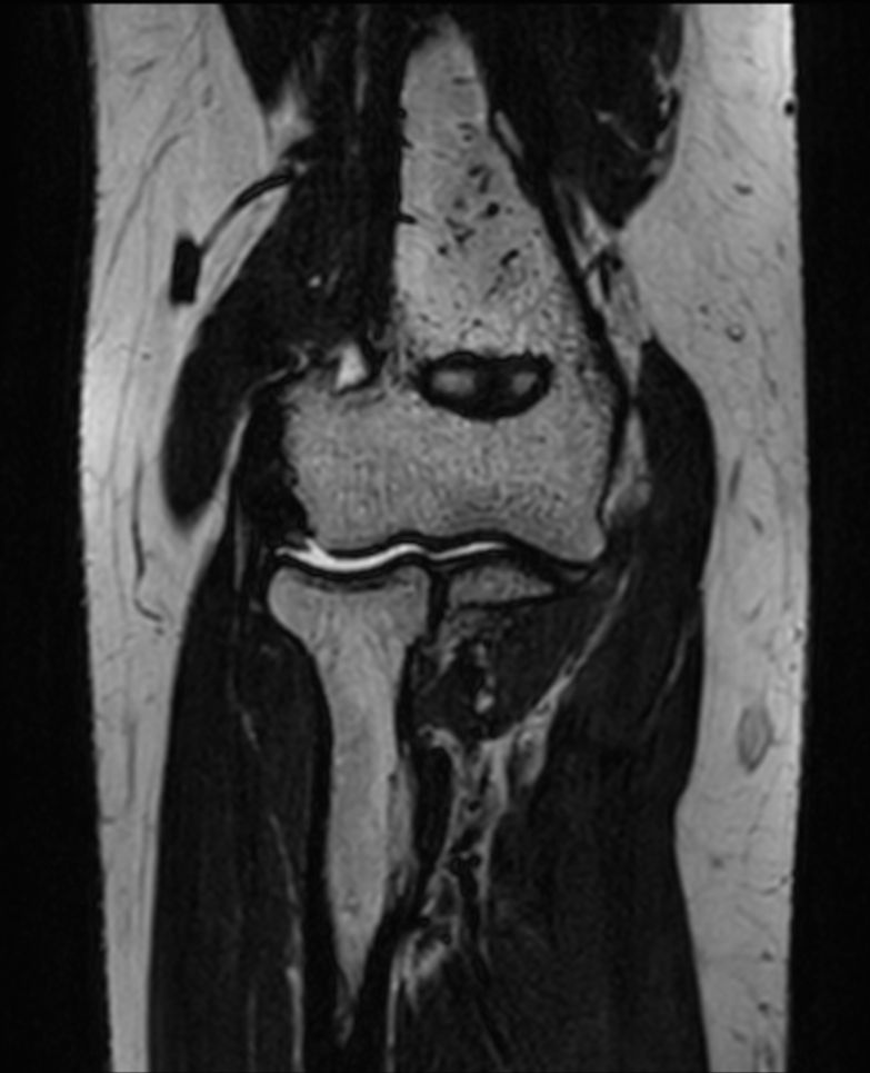 Coronal 3D VIEW T2w TSE