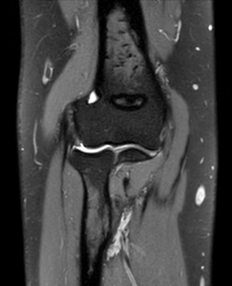 Coronal 3D VIEW PDw SPAIR