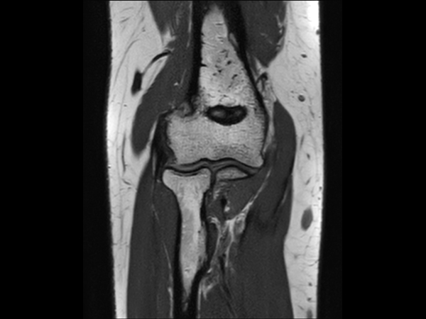 Coronal 3D VIEW PDw TSE