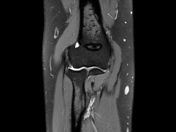 Coronal 3D VIEW PDw SPAIR