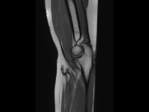 Sagittal PDw TSE