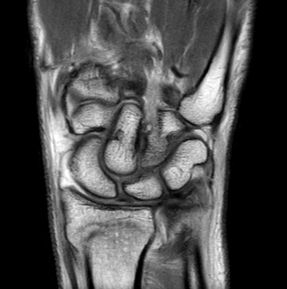 Coronal PDw TSE mDIXON XD (In Phase)