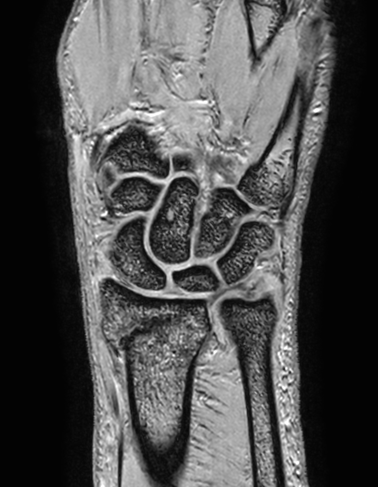 Coronal 3D FFE with Compressed SENSE