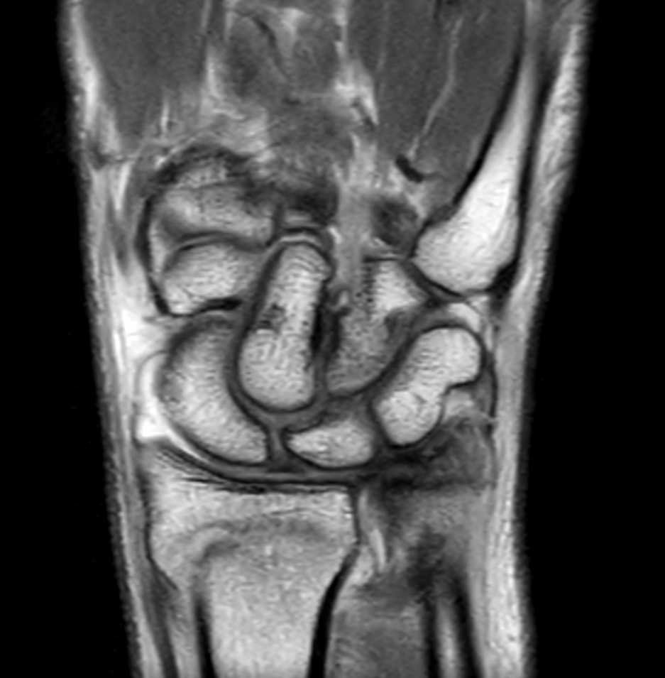 Coronal PDw TSE mDIXON XD with Compressed SENSE (In Phase)