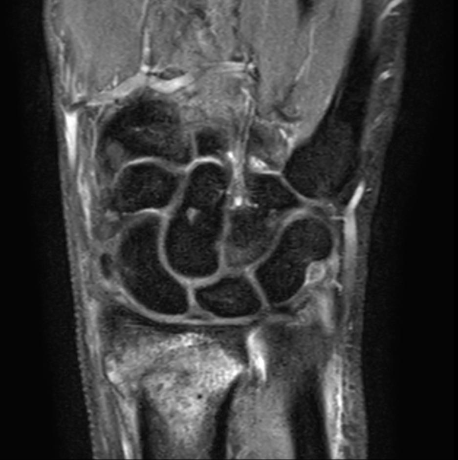 Coronal PDw TSE mDIXON XD (Water only)