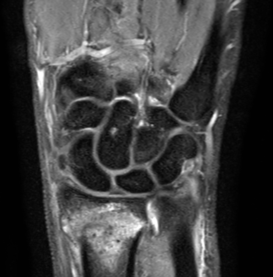 Coronal PDw TSE mDIXON XD with Compressed SENSE (Water only)