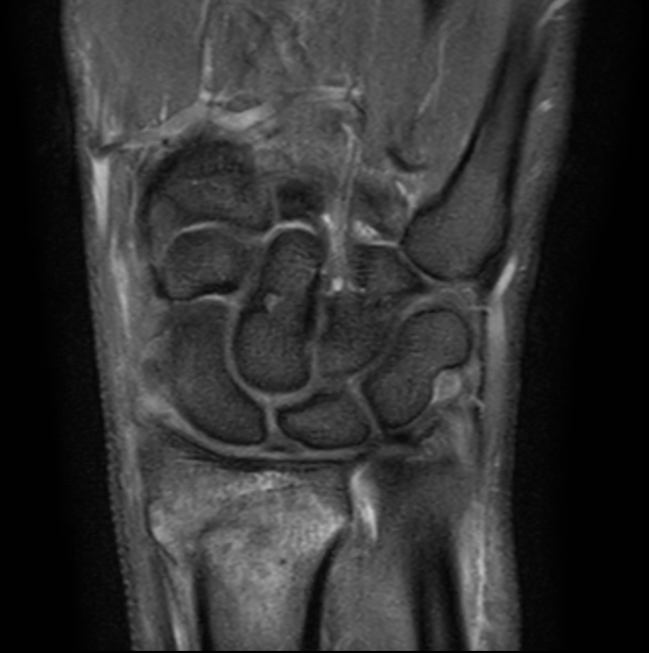 Coronal PDw TSE mDIXON XD (Partial FatSat)
