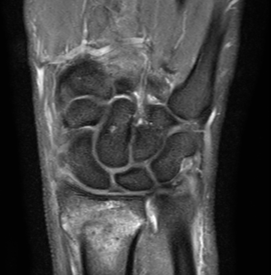Coronal PDw TSE mDIXON XD with Compressed SENSE (Partial FatSat)