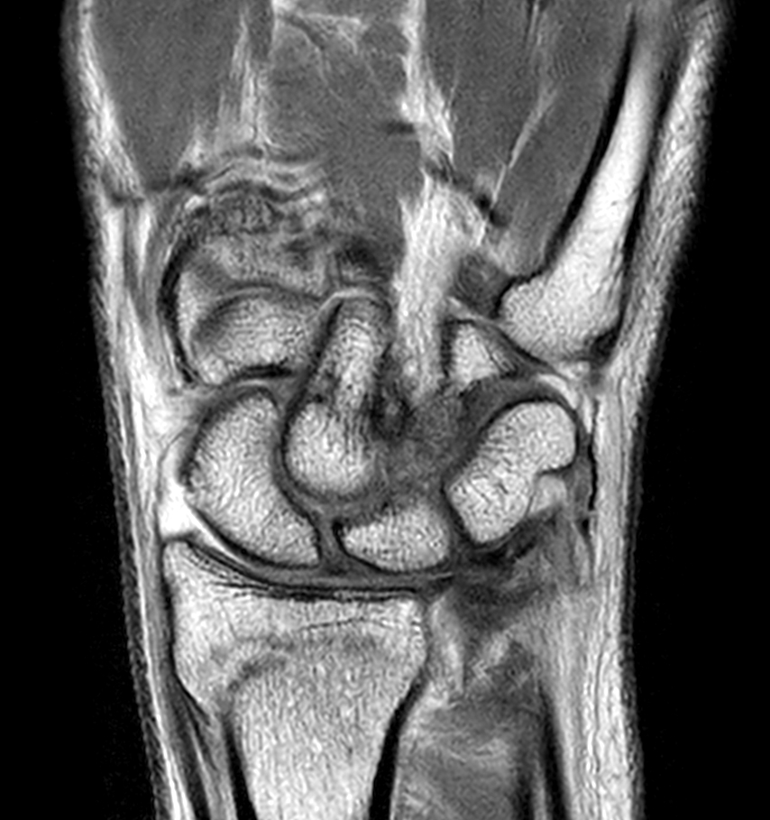 Coronal PDw TSE with Compressed SENSE