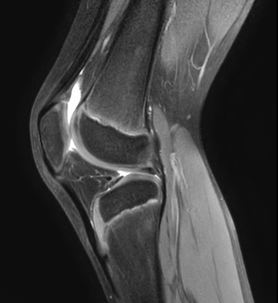 Sagittal PDw SPAIR
