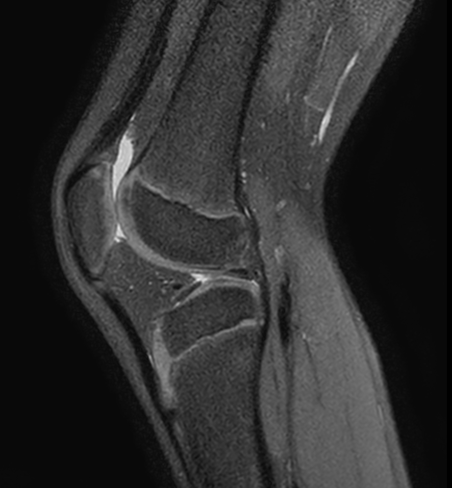 Sagittal 3D VIEW PDw SPAIR