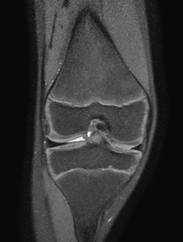 3D VIEW PDw SPAIR - Coronal reformat
