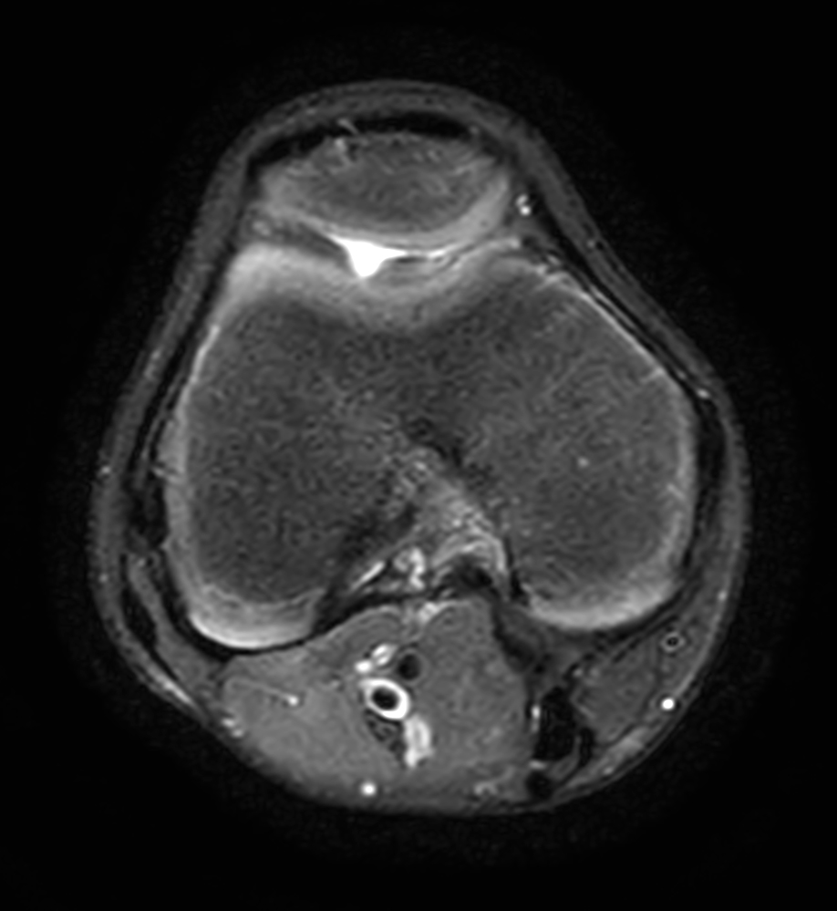 3D VIEW PDw SPAIR - Axial reformat