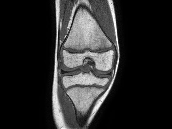 Coronal T1w TSE