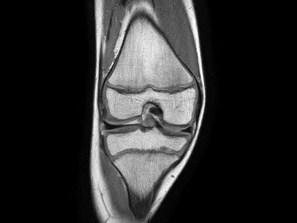 Coronal PDw TSE