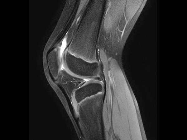 Sagittal PDw SPAIR