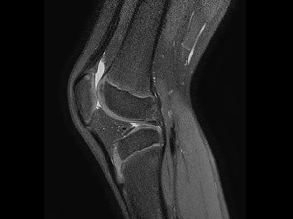 Sagittal 3D VIEW PDw SPAIR