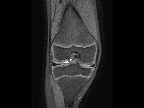 3D VIEW PDw SPAIR - Coronal reformat