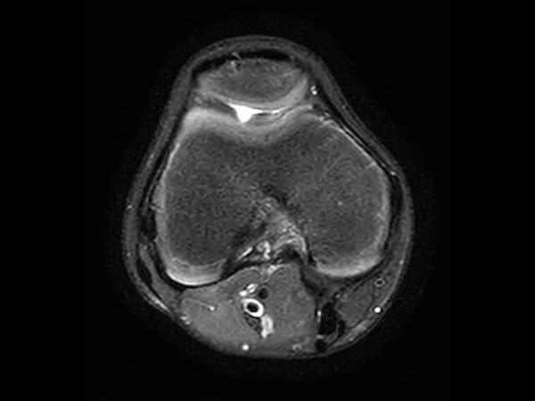 3D VIEW PDw SPAIR - Axial reformat