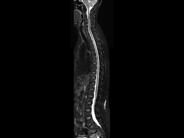 Sagittal T2w TSE mDIXON XD (Water only)