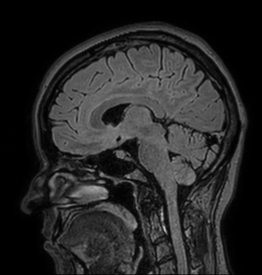 Sagittal 3D BrainVIEW FLAIR