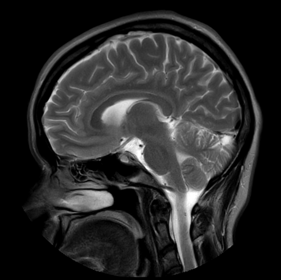 Sagittal T2w TSE MultiVane XD
