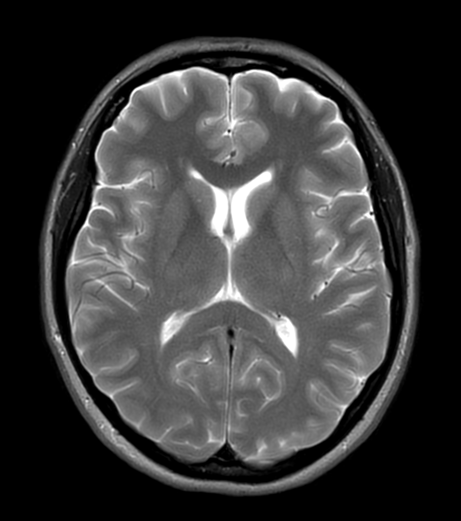 Axial T2w TSE MultiVane XD