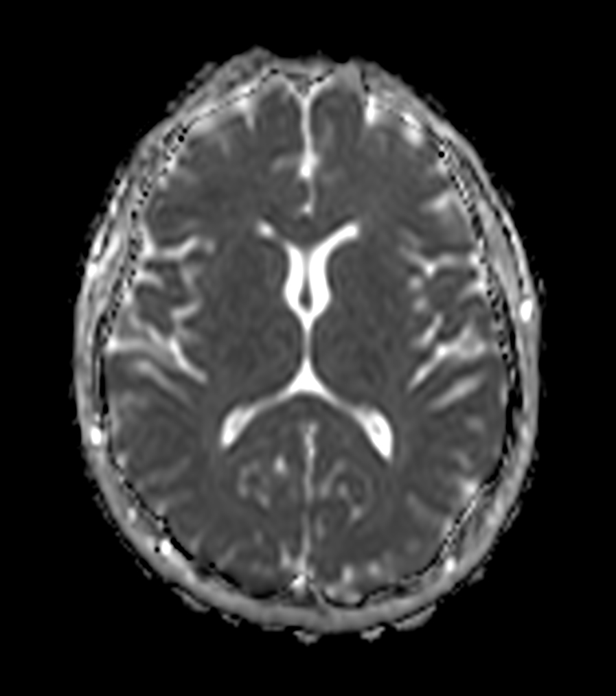 Axial DWI (ADC)