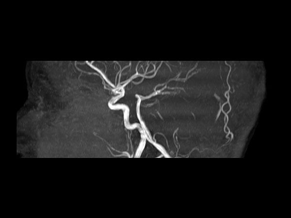 Sagittal 3D Inflow