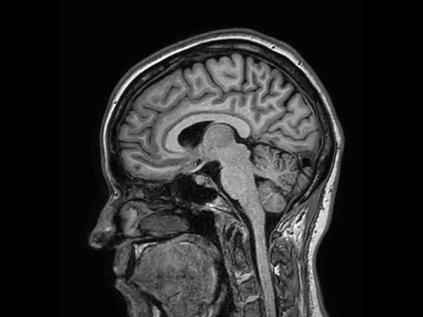 Sagittal 3D T1w TFE