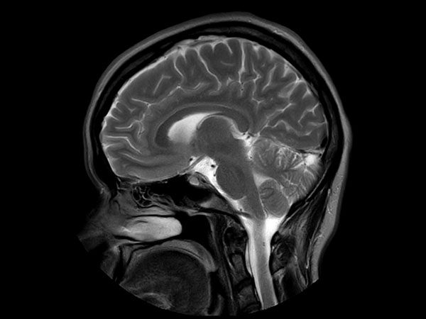 Sagittal T2w TSE MultiVane XD