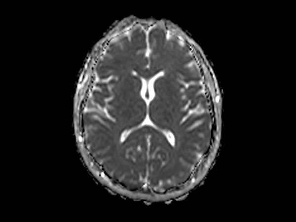 Axial DWI (ADC)