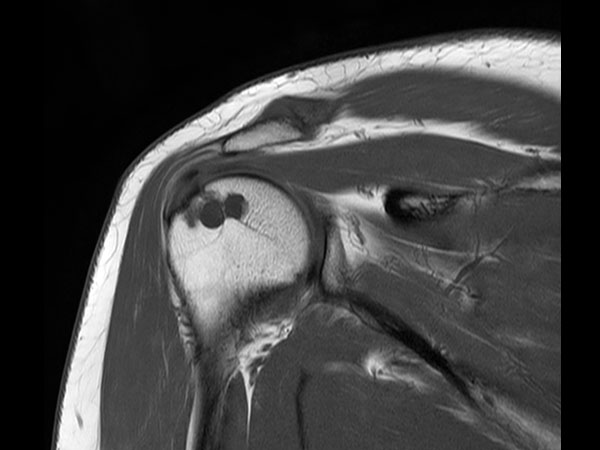 Coronal T1w TSE