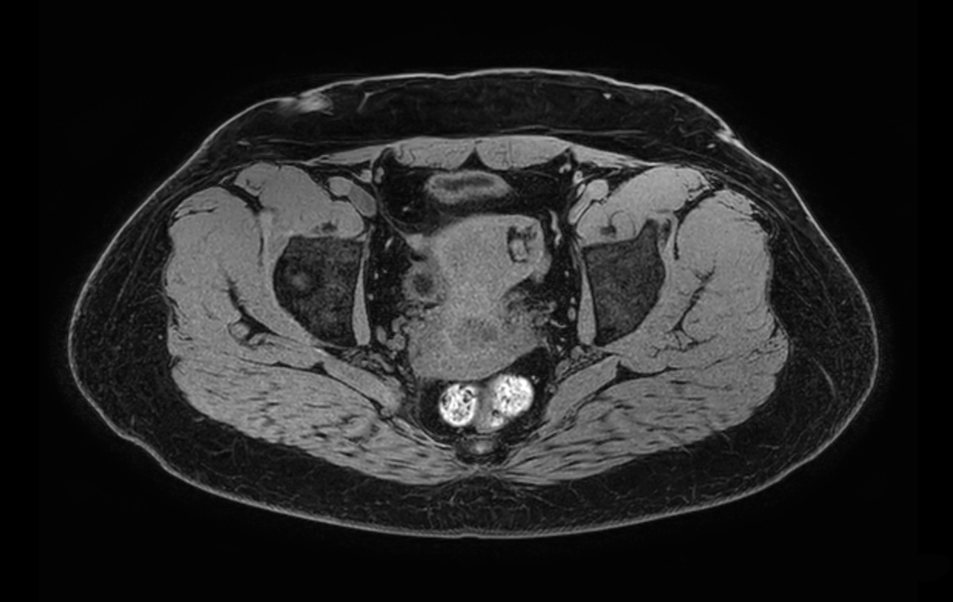 Axial T1w FFE mDIXON XD (Water only)