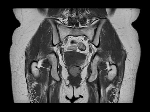 Coronal T1w TSE