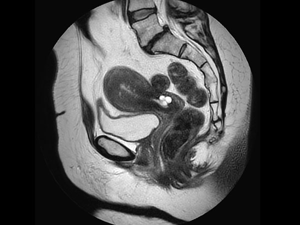 Sagittal T2w TSE MultiVane XD