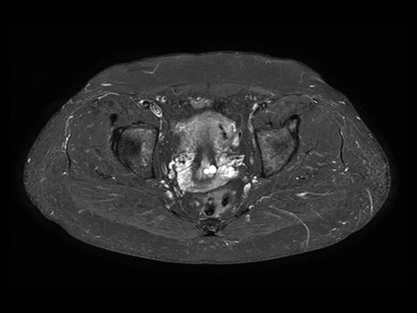 Axial STIR TSE