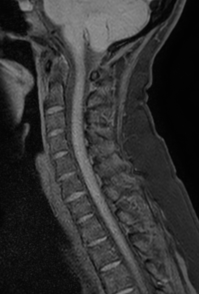 Sagittal T1w TSE mDIXON XD (Water only)