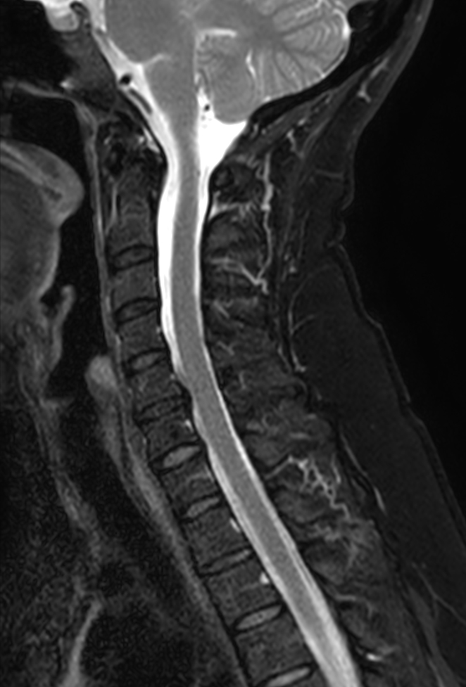 Sagittal T2w TSE mDIXON XD (Water only)