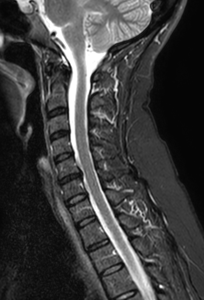 Sagittal STIR TSE