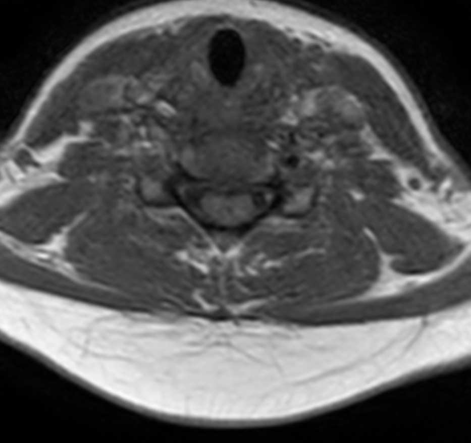 Axial T1w TSE (small FOV)