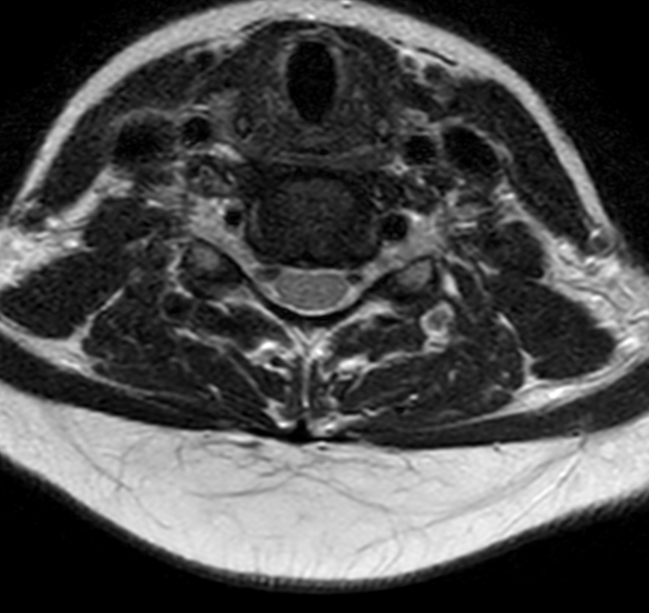 Axial T2w TSE (small FOV)