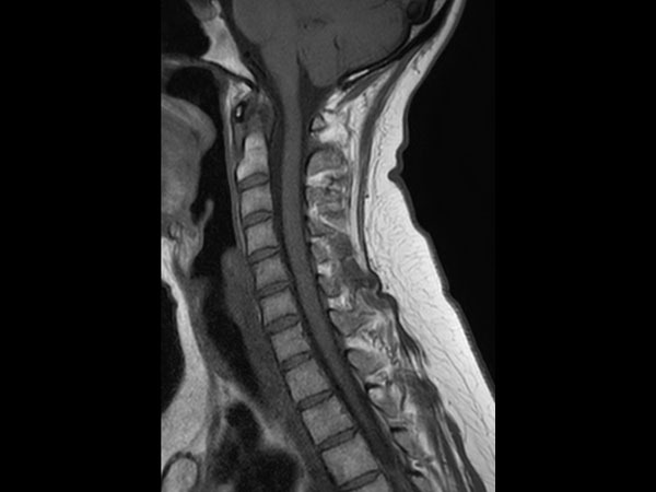 Sagittal T1w TSE