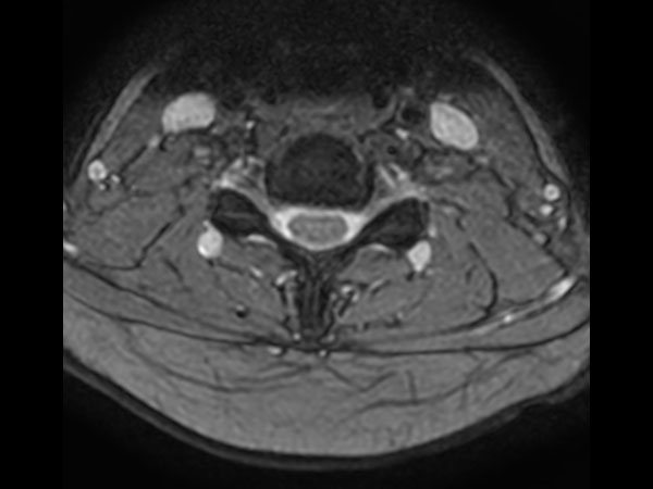 Axial mFFE (small FOV)