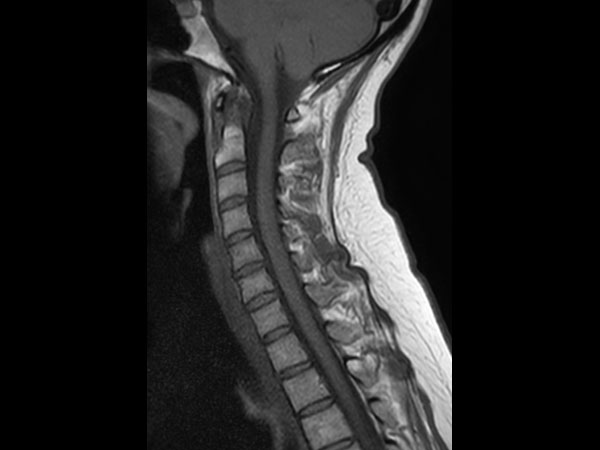 Sagittal T1w TSE mDIXON XD (In Phase)