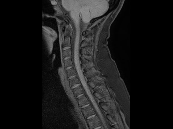 Sagittal T1w TSE mDIXON XD (Water only)