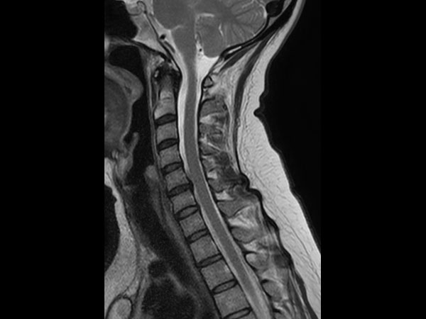 Sagittal T2w TSE mDIXON XD (In Phase)