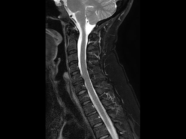 Sagittal T2w TSE mDIXON XD (Water only)