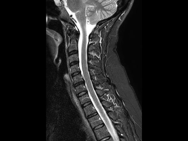 Sagittal STIR TSE