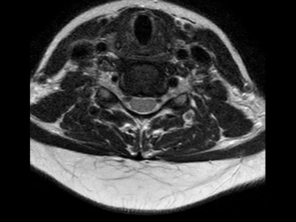 Axial T2w TSE (small FOV)